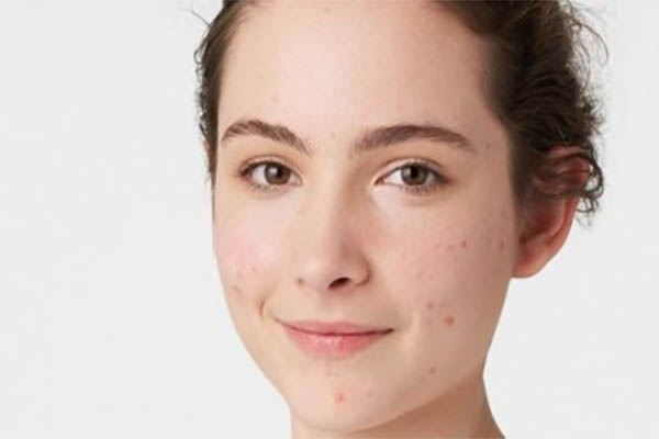  Understanding Oily/Acne Prone Skin